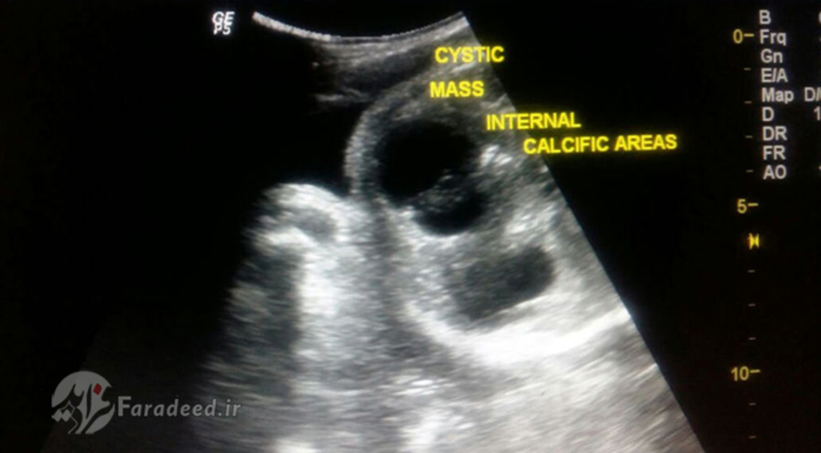 تصویر سونگرافی از توده داخل شکم نوزاد قبل از عمل