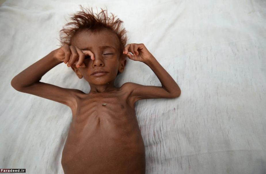 پسر مبتلا به سوءتغذیه در یمن