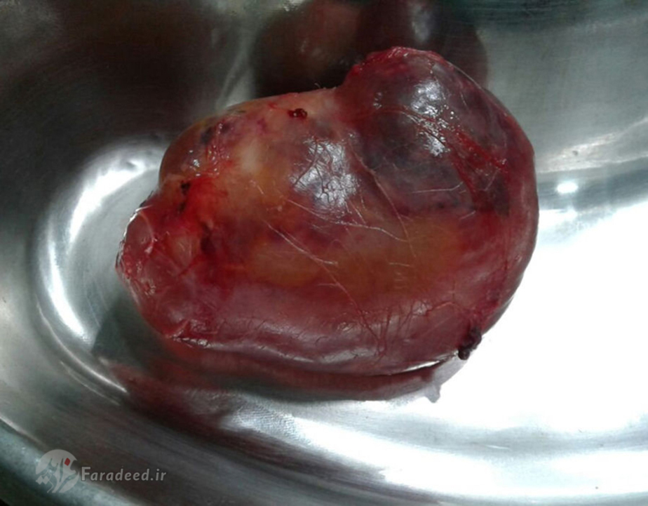 توده خارج شده از شکم نوزاد