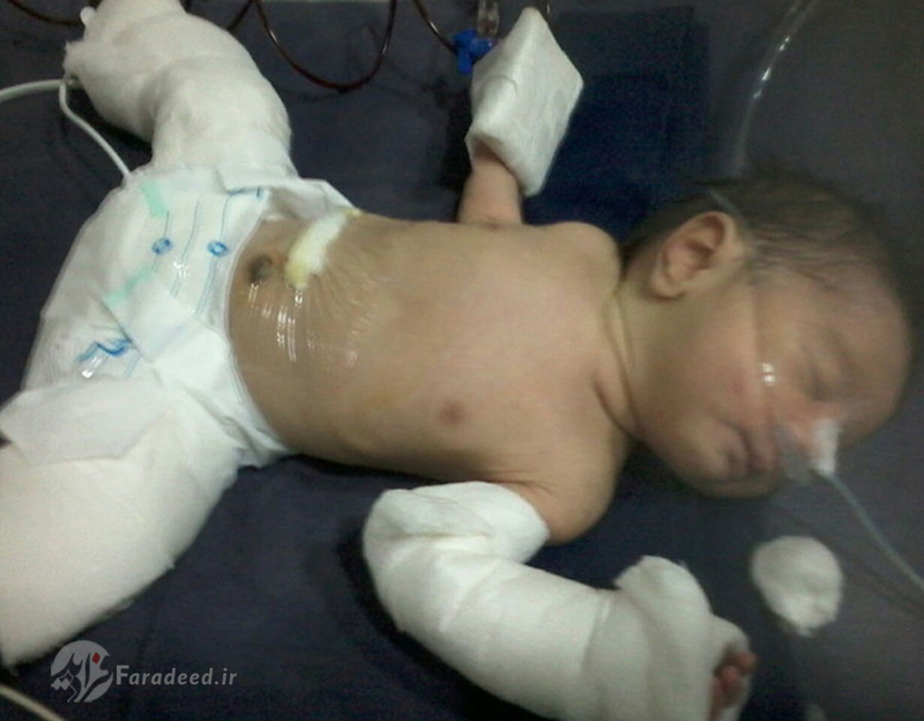 نوزاد پس از عمل جراحی و خارج کردن توده